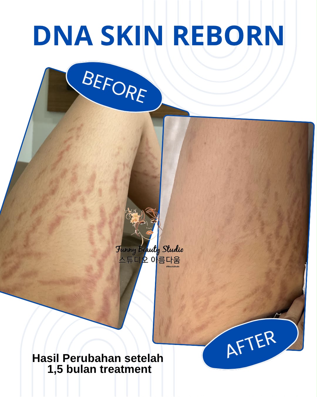 DNA Skin Reborn For Strechmark