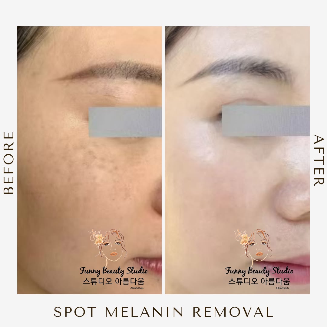 Spot Melanin Removal