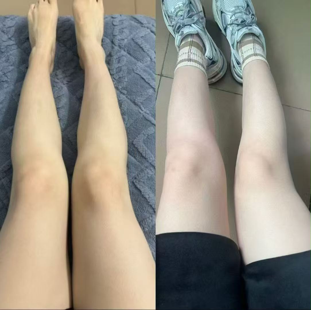 Microbleaching/Body Whitening